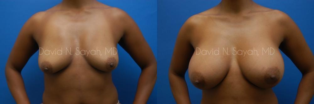 Breast Augmentation Before and After | Sayah Institute