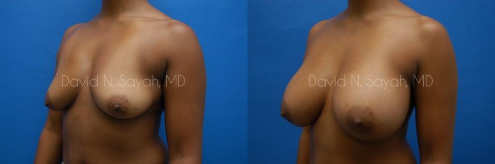 Breast Augmentation Before and After | Sayah Institute