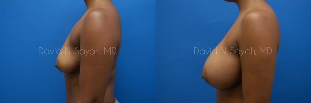 Breast Augmentation Before and After | Sayah Institute