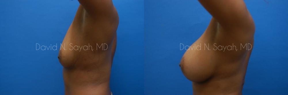 Breast Augmentation Before and After | Sayah Institute