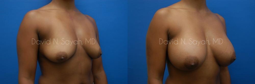 Breast Augmentation Before and After | Sayah Institute