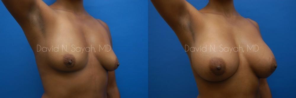 Breast Augmentation Before and After | Sayah Institute