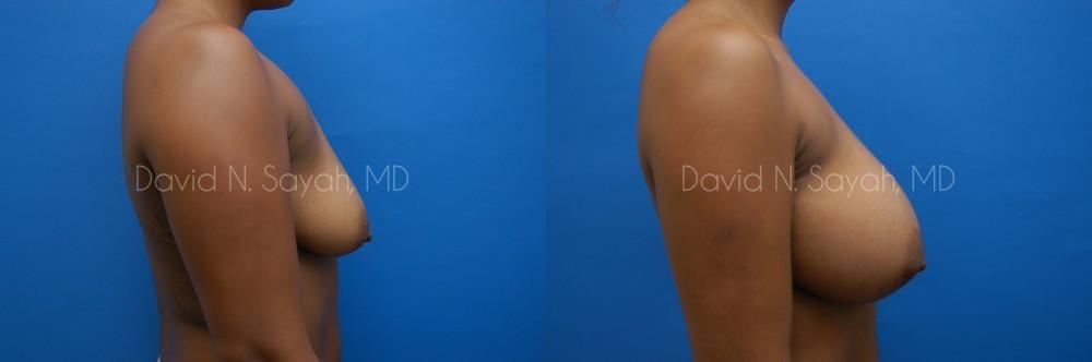 Breast Augmentation Before and After | Sayah Institute