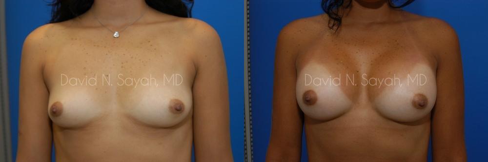 Breast Augmentation Before and After | Sayah Institute