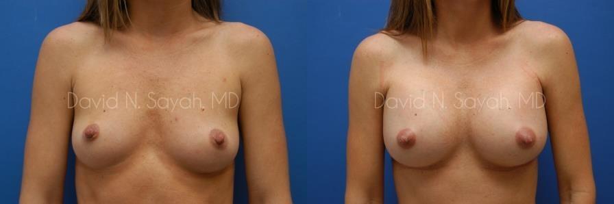 Breast Augmentation Before and After | Sayah Institute