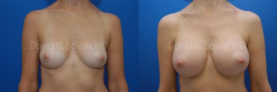 Breast Augmentation Before and After | Sayah Institute