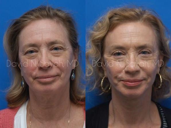 Brow Lift Before and After | Sayah Institute