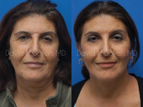Facelift Before and After | Sayah Institute