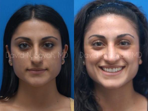 Rhinoplasty Before and After | Sayah Institute