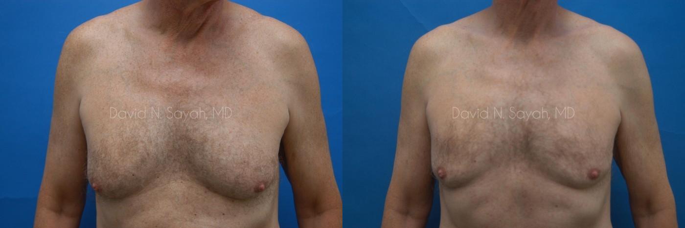 Male Breast Surgery Before and After | Sayah Institute