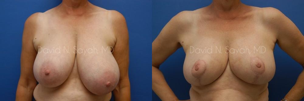 Breast Reduction Before and After | Sayah Institute