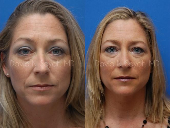 Rhinoplasty Before and After | Sayah Institute