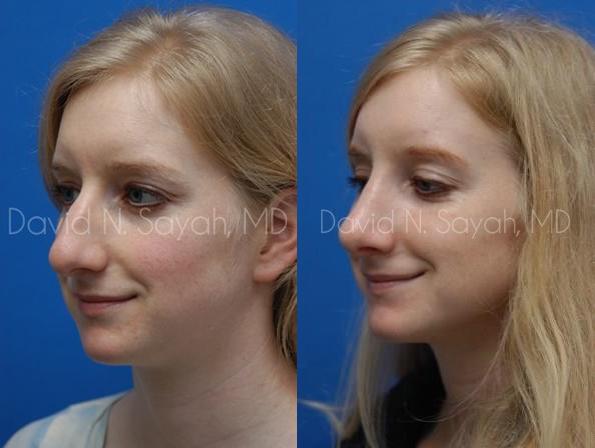 Rhinoplasty Before and After | Sayah Institute