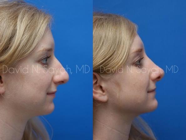 Rhinoplasty Before and After | Sayah Institute