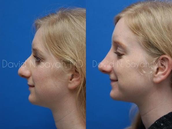 Rhinoplasty Before and After | Sayah Institute