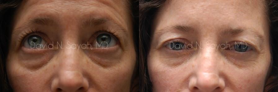 Eyelid Surgery Before and After | Sayah Institute