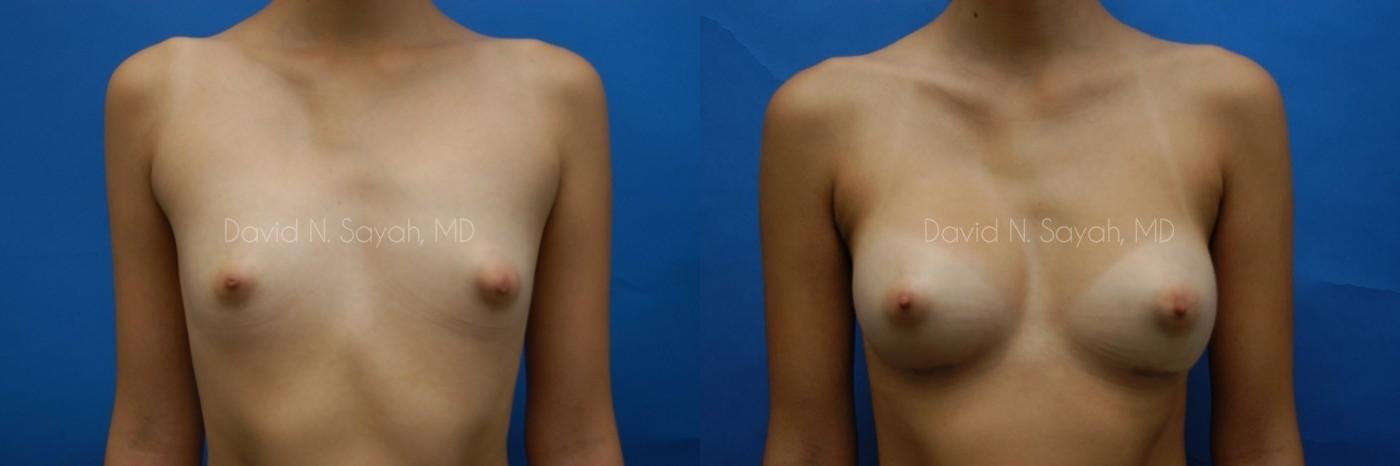 Breast Augmentation Before and After | Sayah Institute