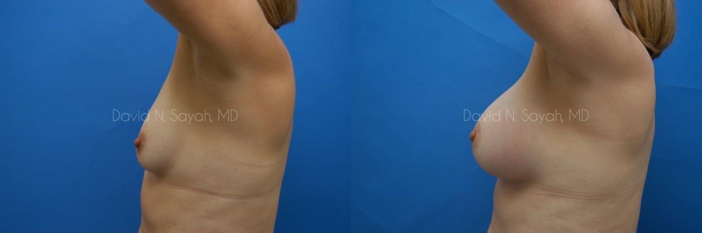 Breast Augmentation Before and After | Sayah Institute