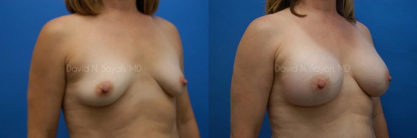 Breast Augmentation Before and After | Sayah Institute