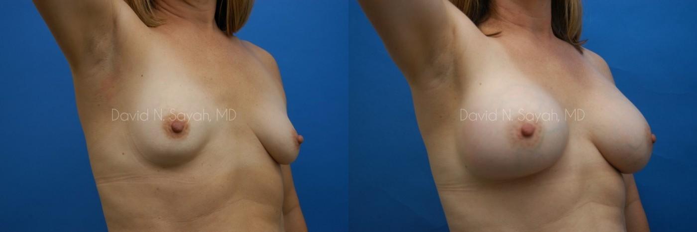 Breast Augmentation Before and After | Sayah Institute