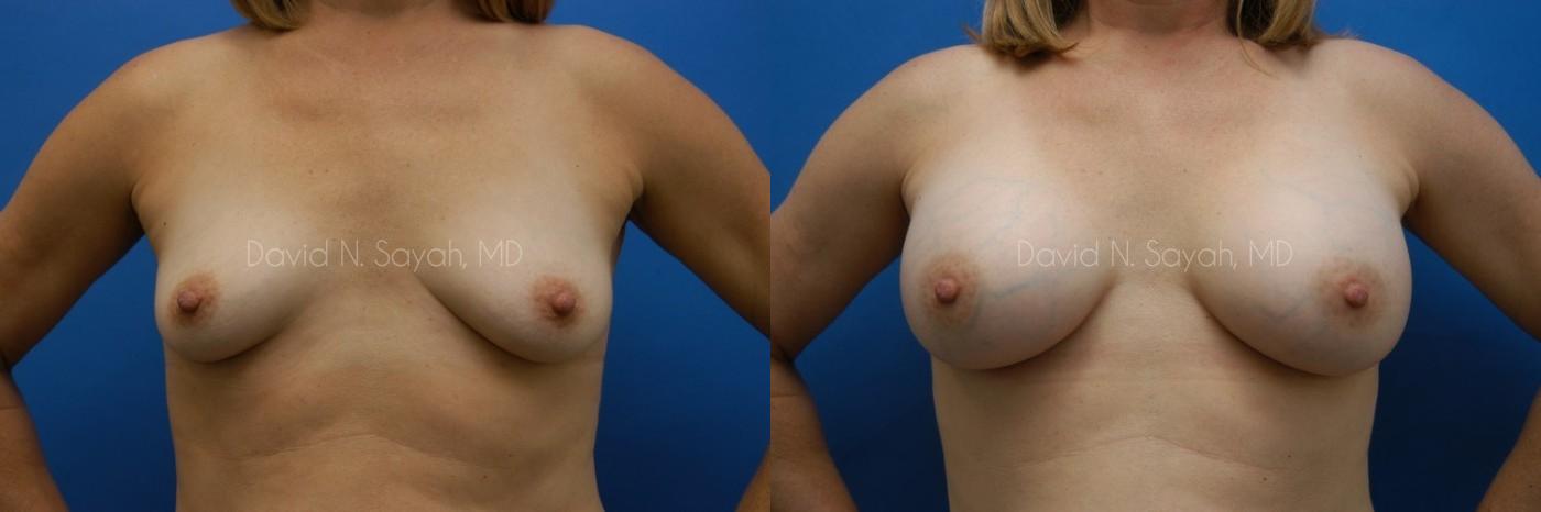 Breast Augmentation Before and After | Sayah Institute