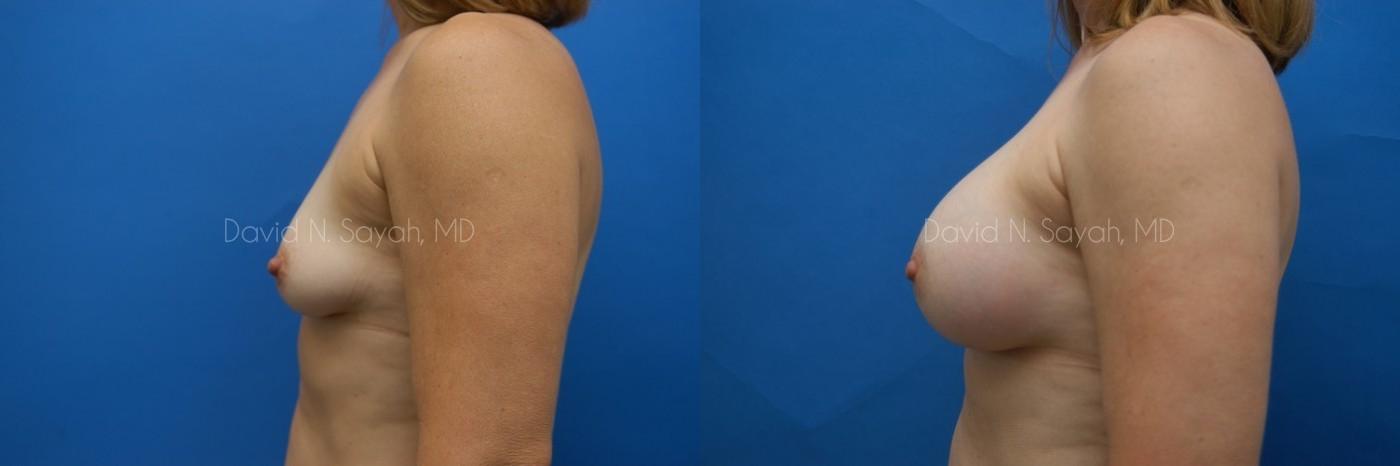 Breast Augmentation Before and After | Sayah Institute
