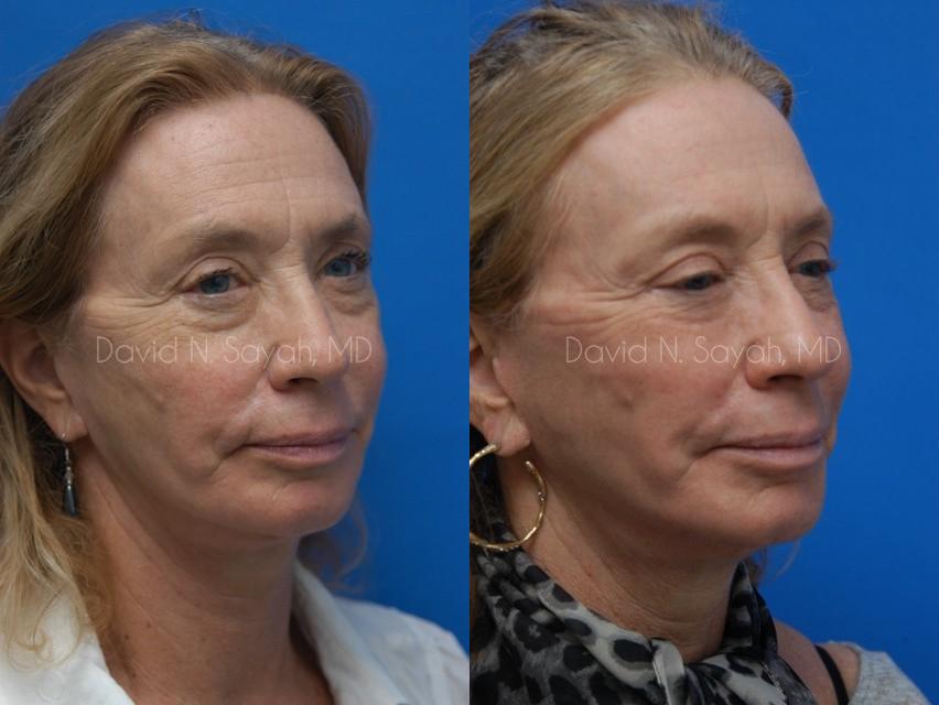 Fat Injection Face Before and After | Sayah Institute