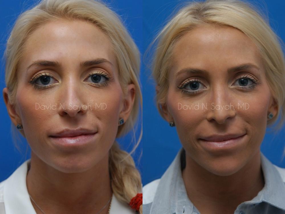 Rhinoplasty Before and After | Sayah Institute