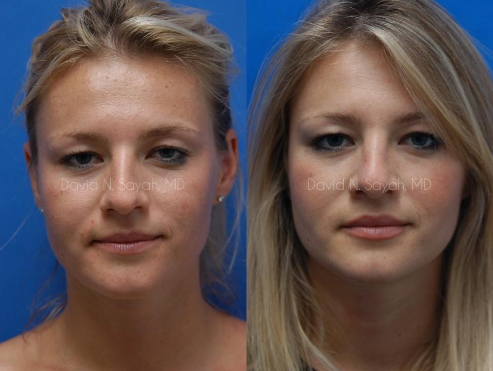 Rhinoplasty Before and After | Sayah Institute