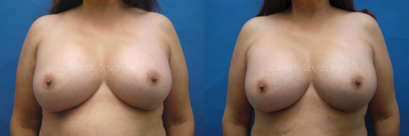 Breast Augmentation Before and After | Sayah Institute