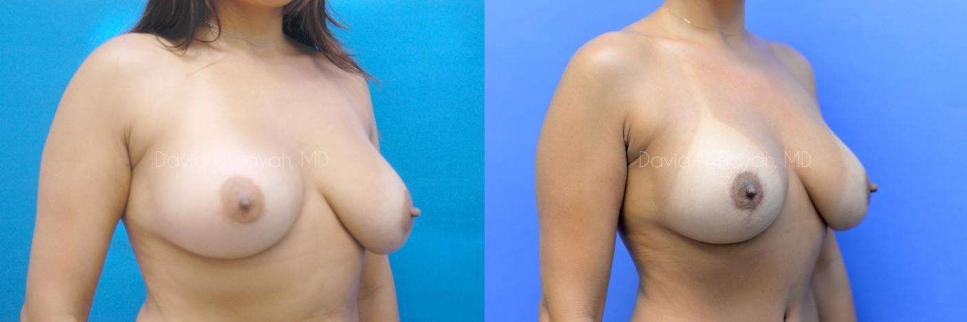 Breast Lift Before and After | Sayah Institute