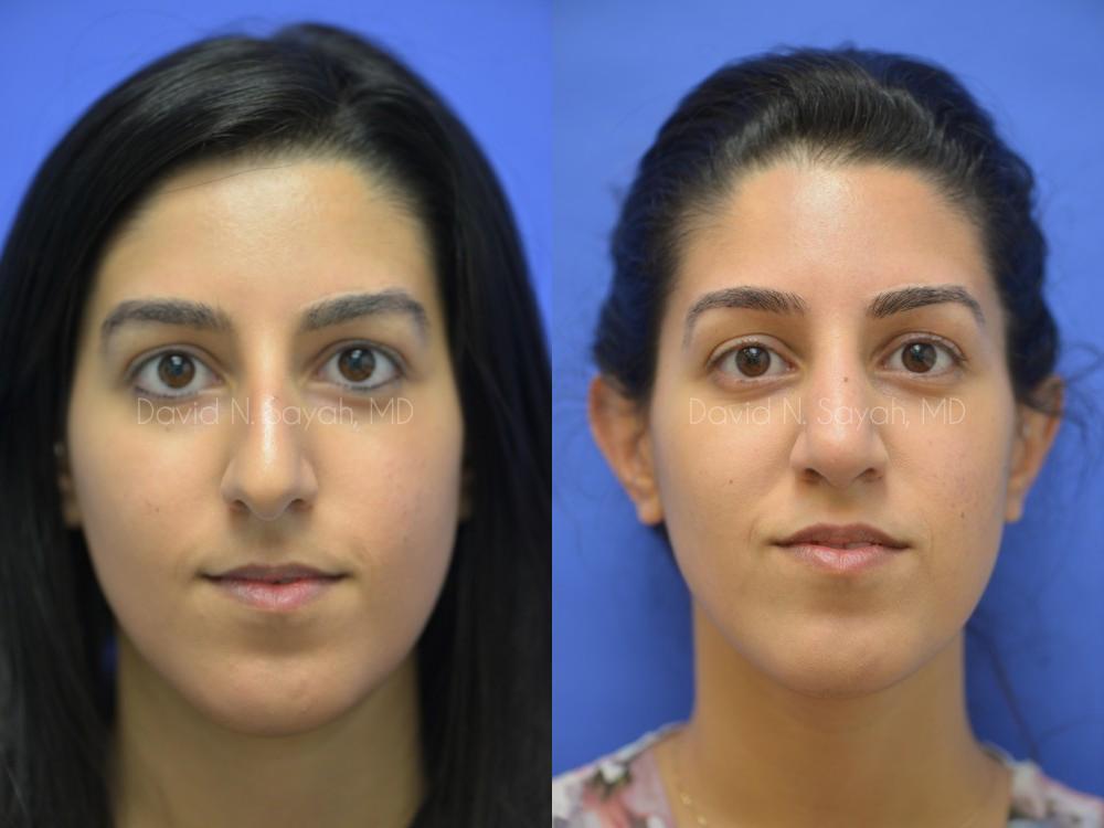Rhinoplasty Before and After | Sayah Institute