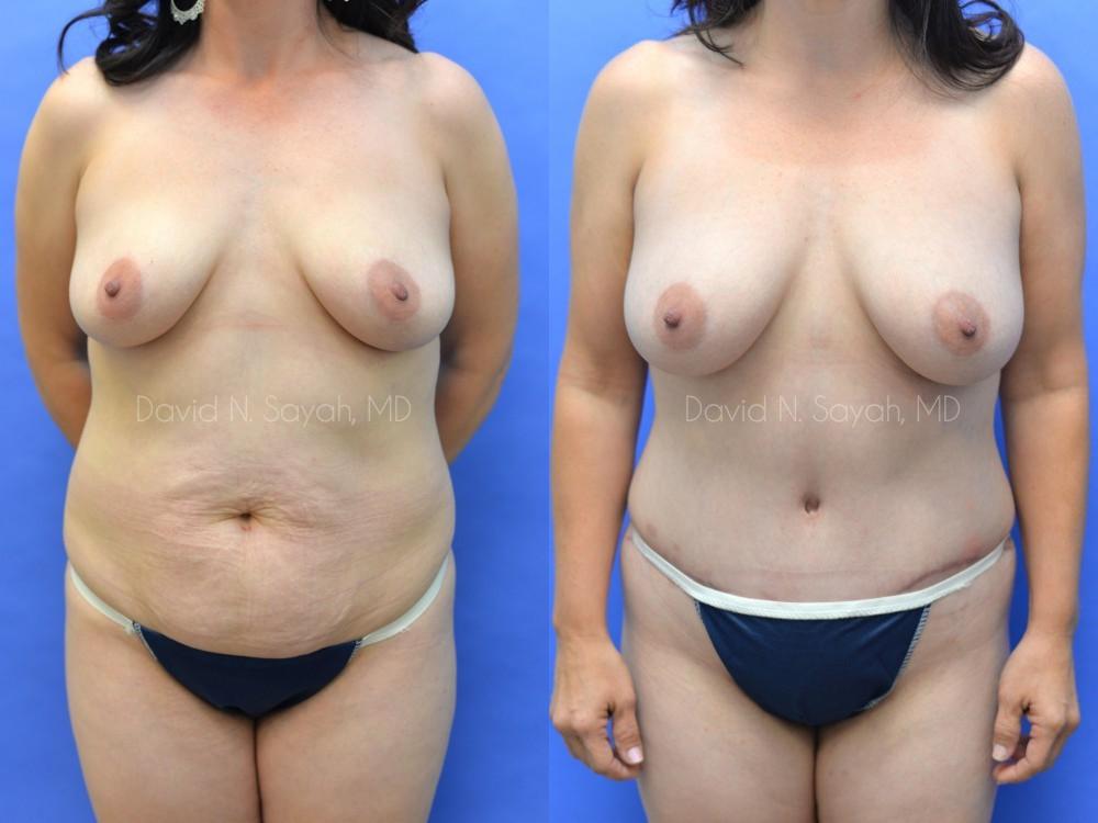 Tummy Tuck Before and After | Sayah Institute