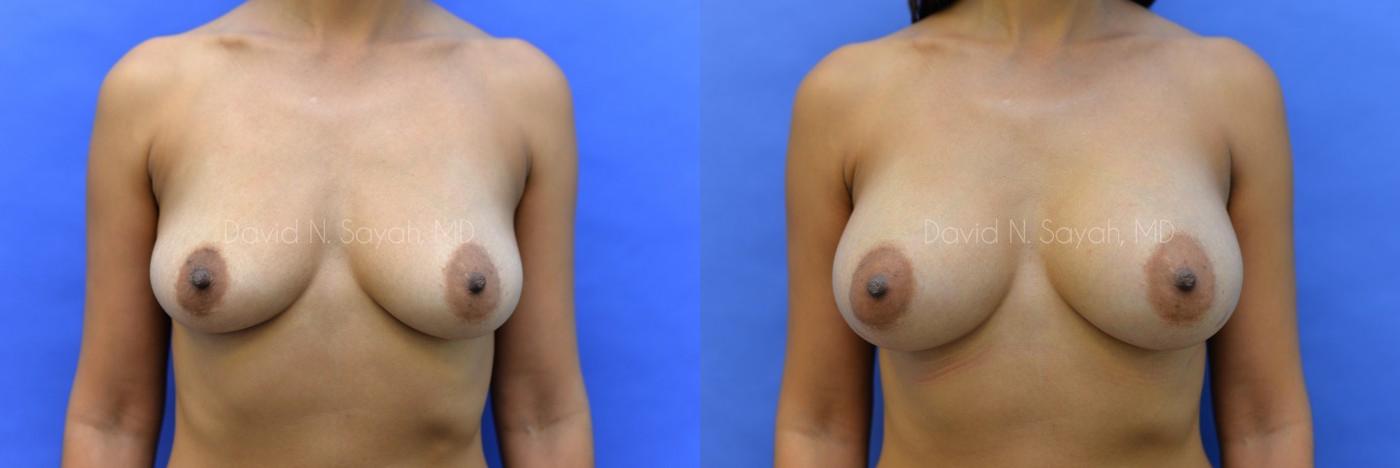 Breast Augmentation Before and After | Sayah Institute