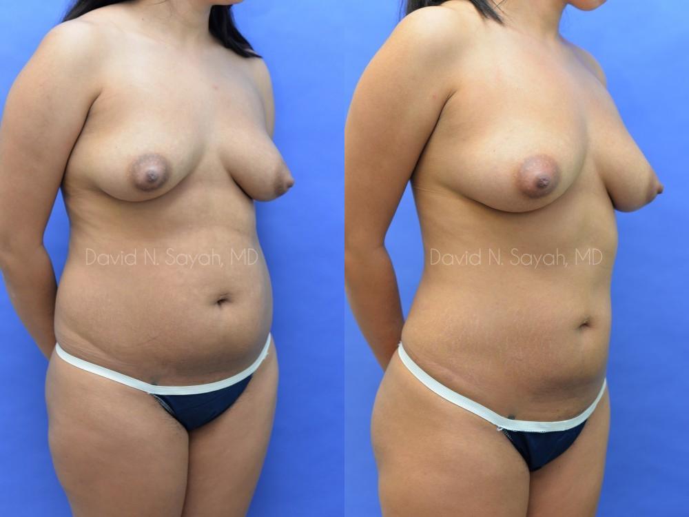 Fat Injection Breast Before and After | Sayah Institute