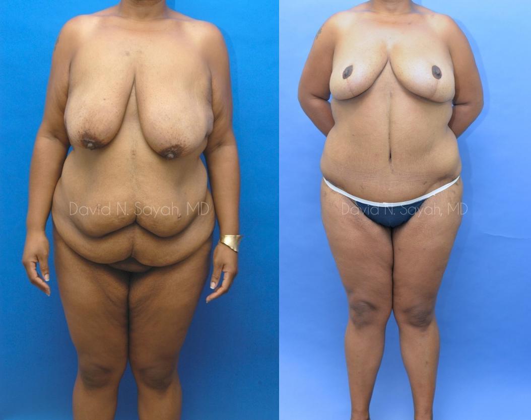 Breast Lift Before and After | Sayah Institute