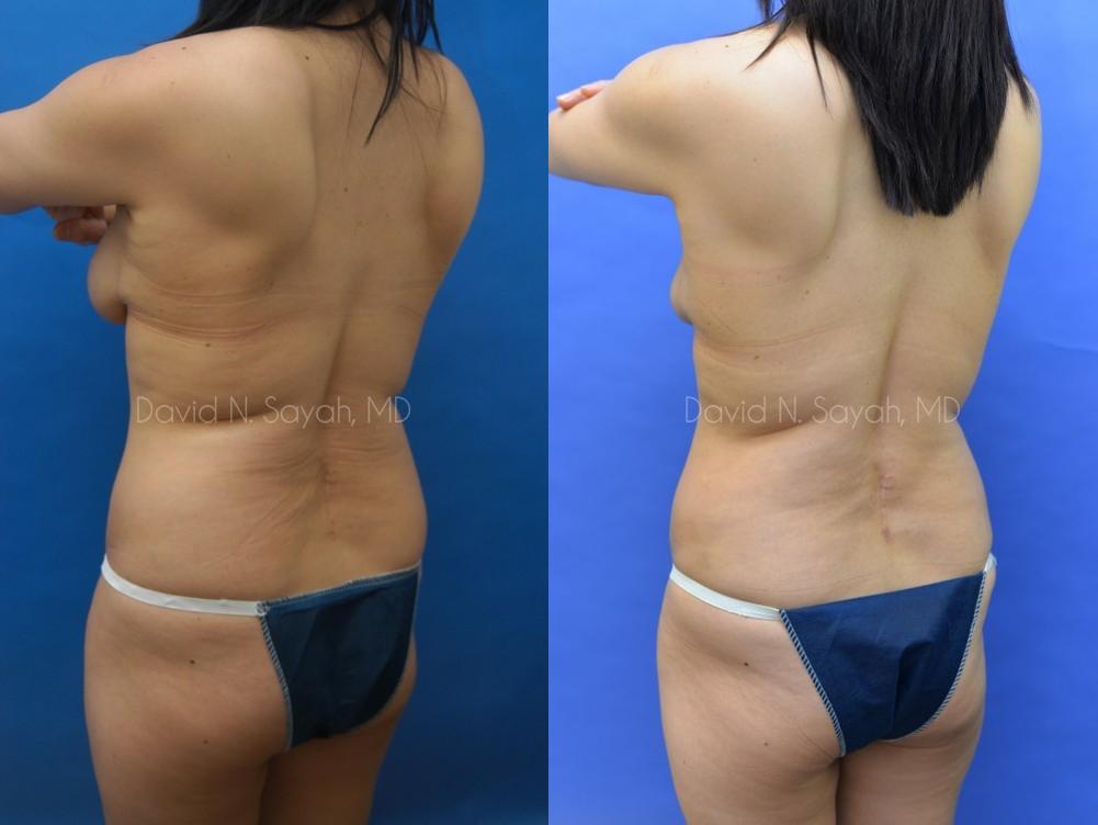 Liposuction Before and After | Sayah Institute