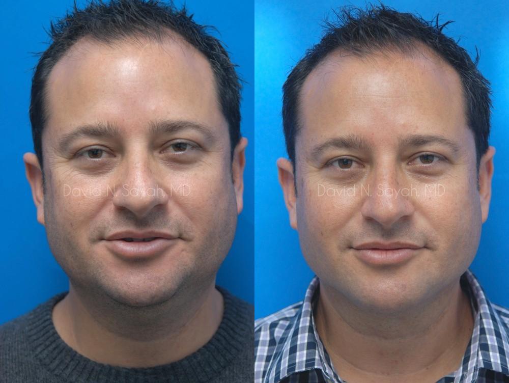 Neck Lift Before and After | Sayah Institute