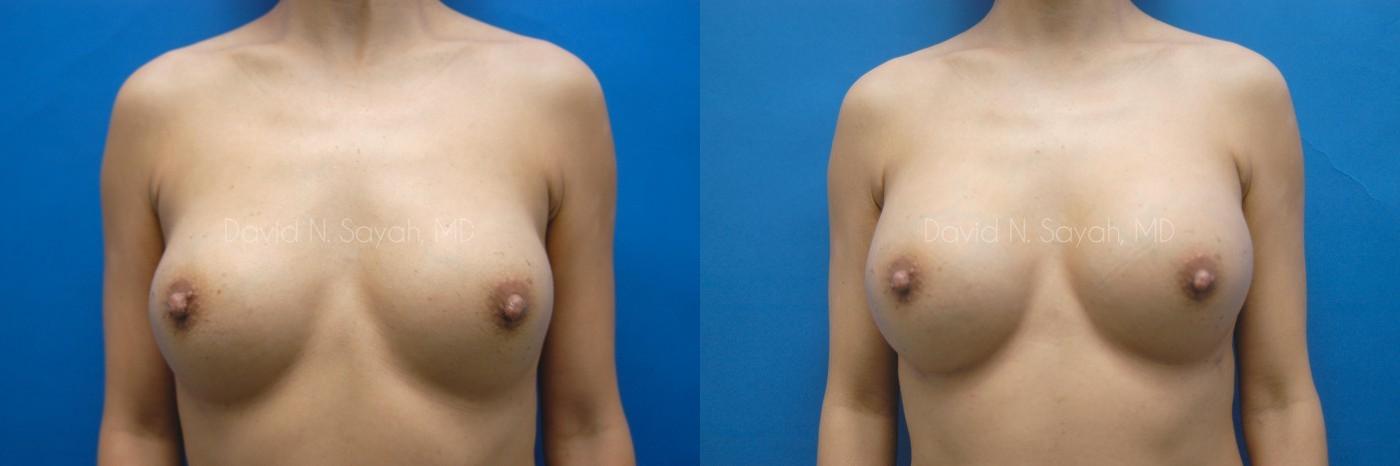 Breast Implant Exchange Before and After | Sayah Institute