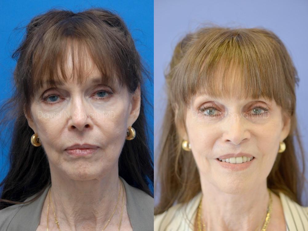 Facelift Before and After | Sayah Institute