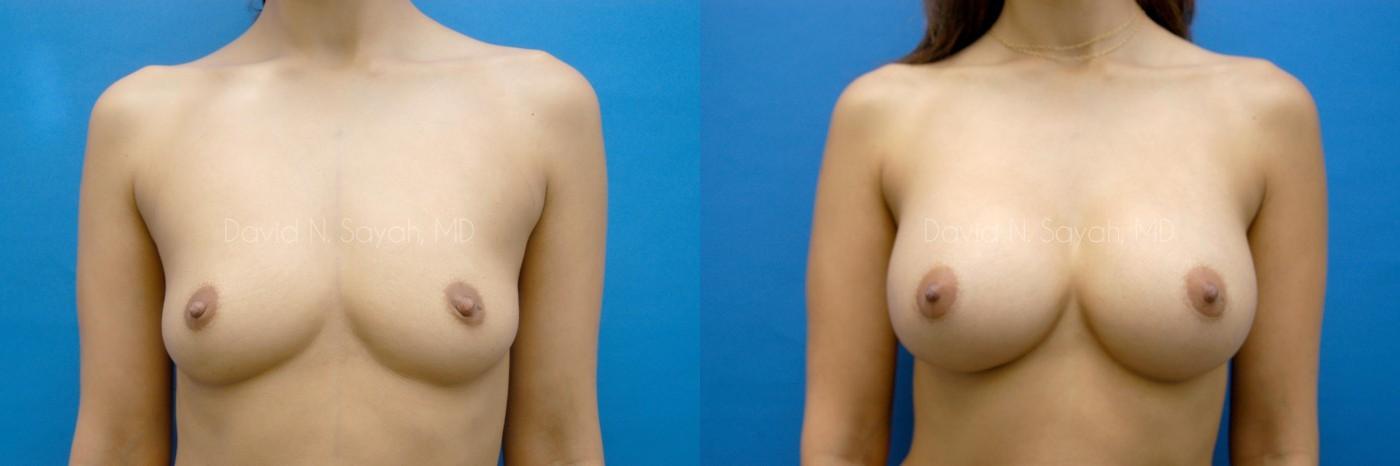 Breast Augmentation Before and After | Sayah Institute