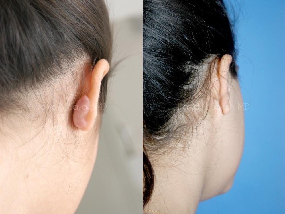 Scar Revision Face Before and After | Sayah Institute