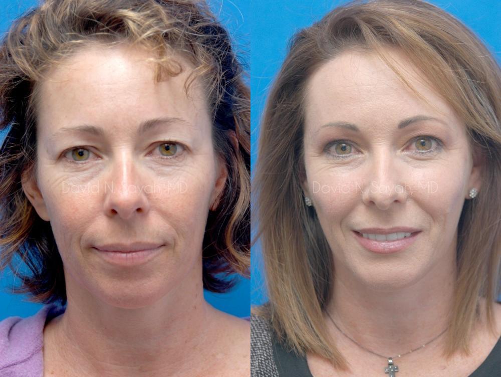 Facelift Before and After | Sayah Institute