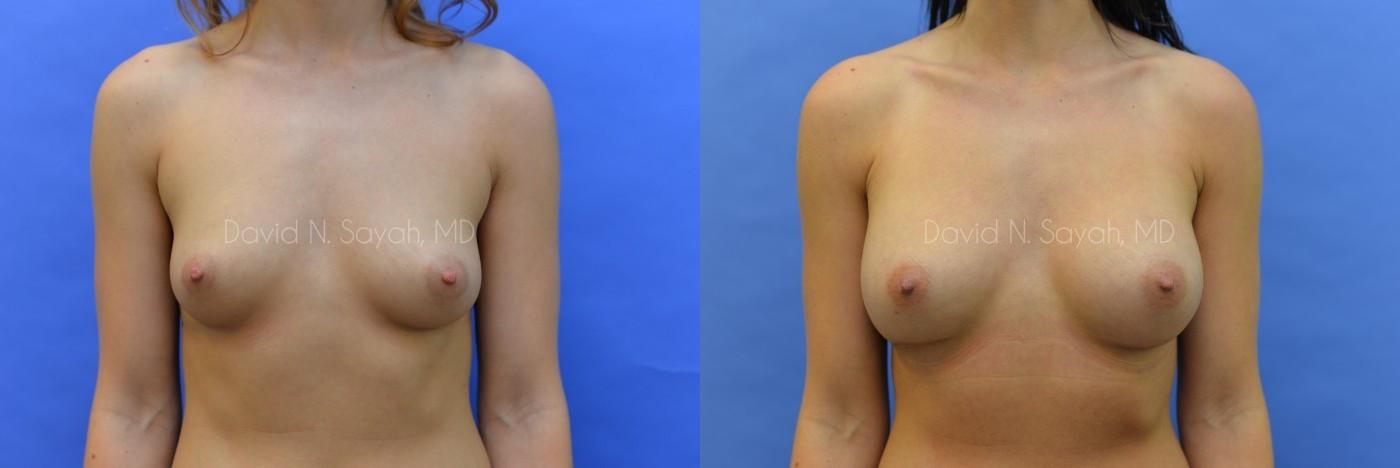 Breast Augmentation Before and After | Sayah Institute