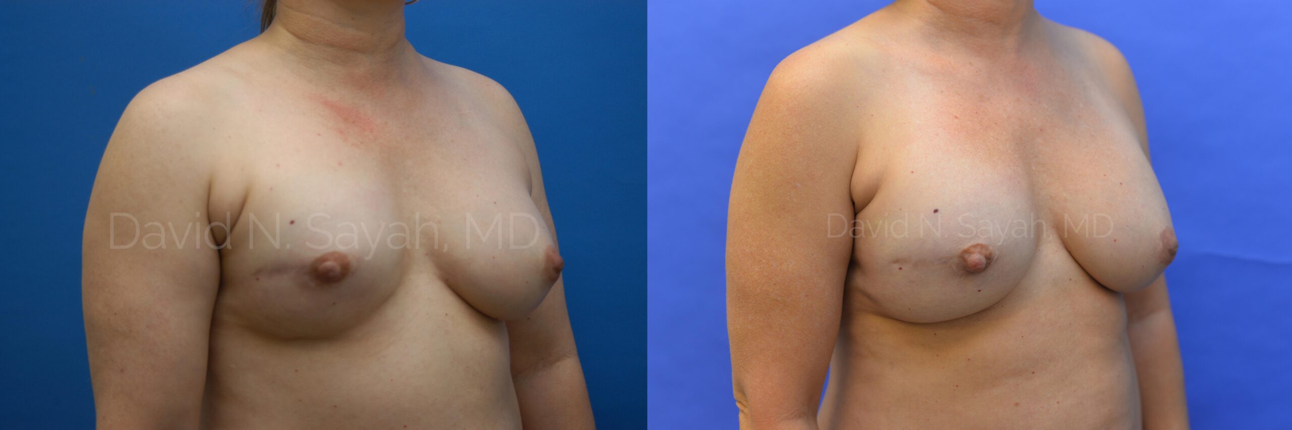 Breast Reconstruction Before and After | Sayah Institute