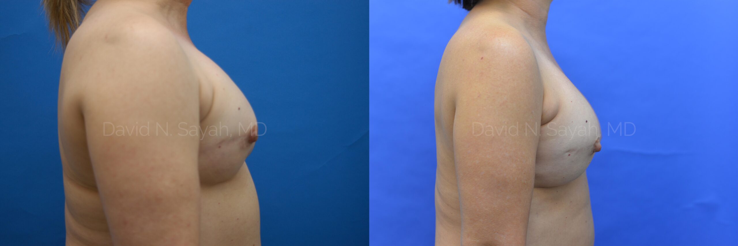 Breast Reconstruction Before and After | Sayah Institute