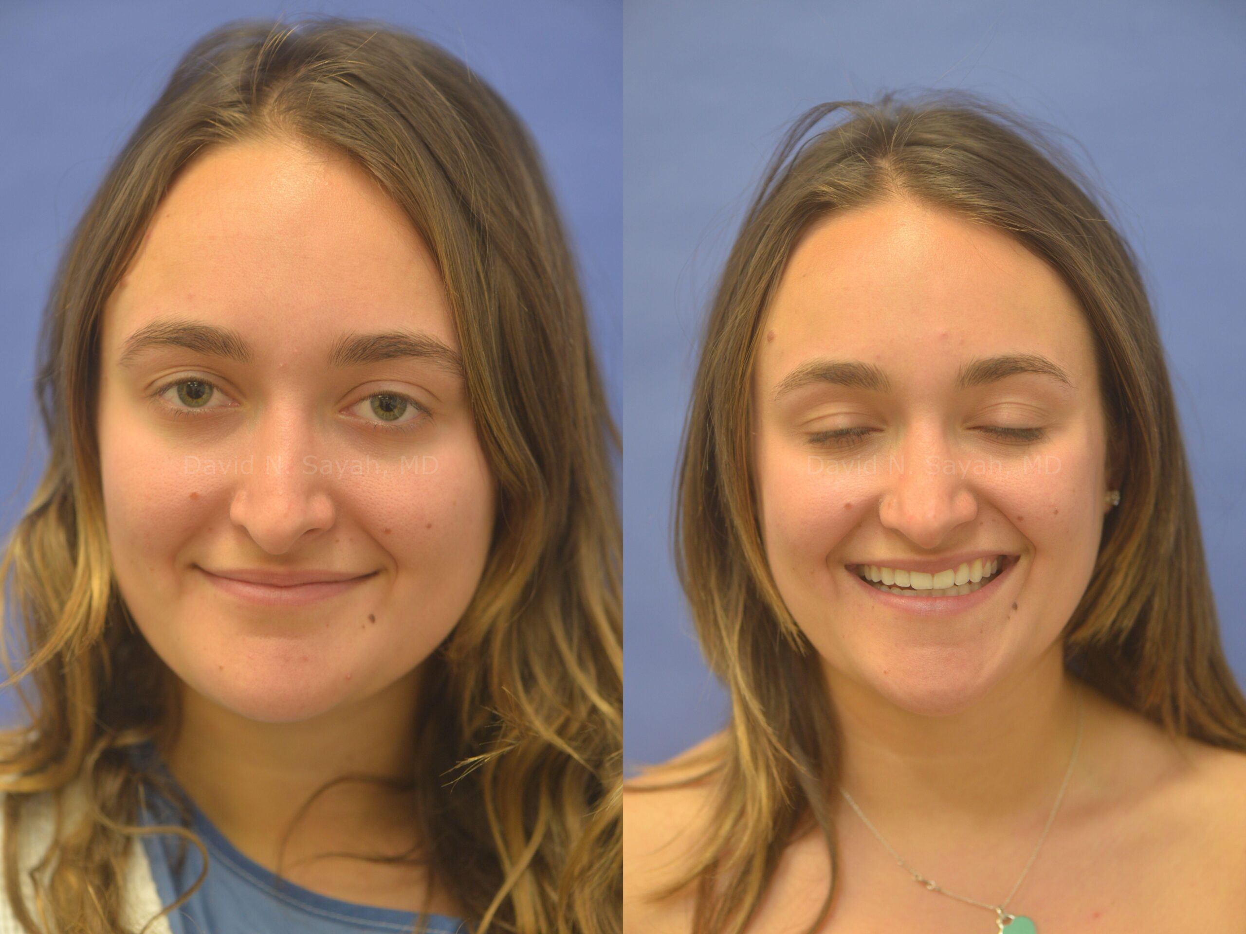 Rhinoplasty Before and After | Sayah Institute