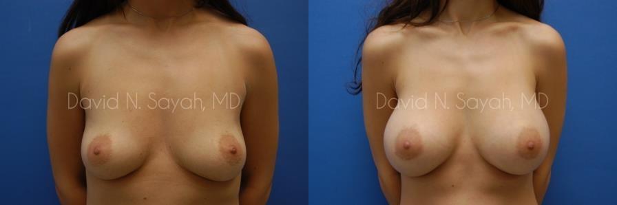 Breast Augmentation Before and After | Sayah Institute