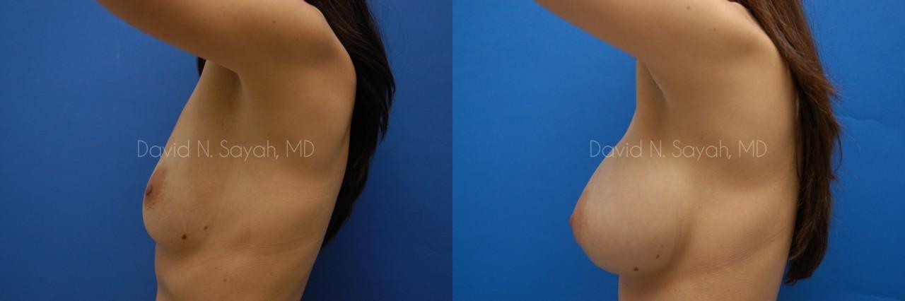 Breast Augmentation Before and After | Sayah Institute