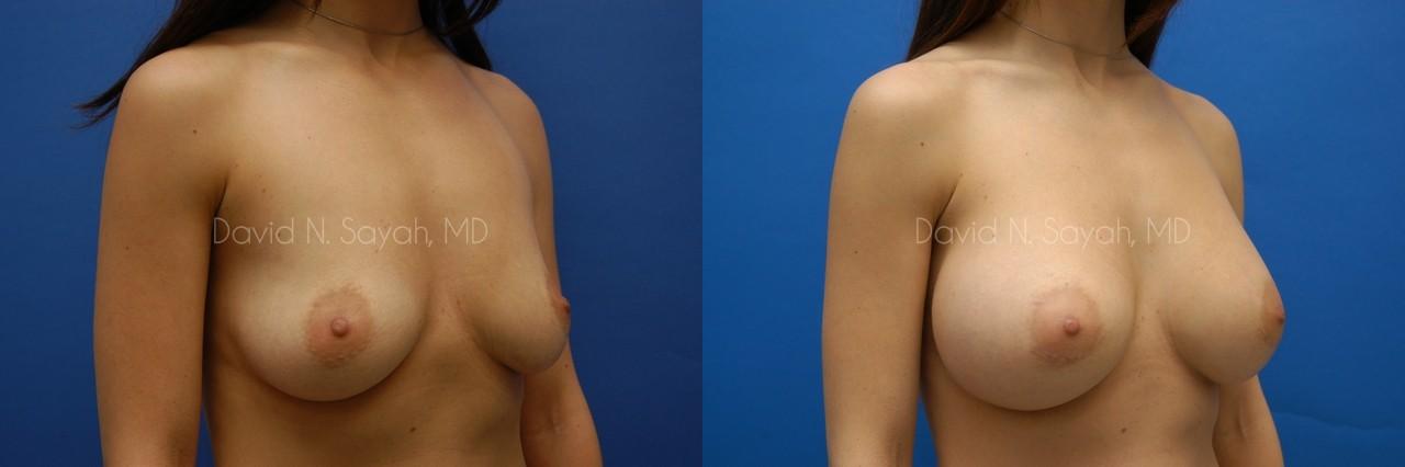 Breast Augmentation Before and After | Sayah Institute